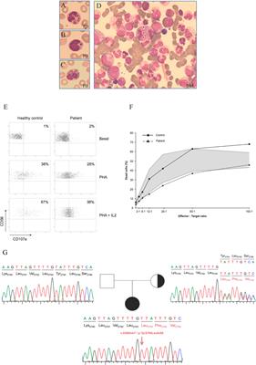 Case Report: Partial Uniparental Disomy Unmasks a Novel Recessive Mutation in the LYST Gene in a Patient With a Severe Phenotype of Chédiak-Higashi Syndrome